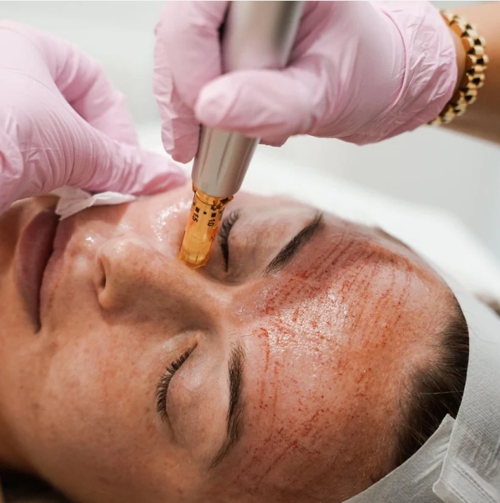 3 Skin Needling