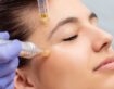 10 Things You Need to Know About Skin Needling