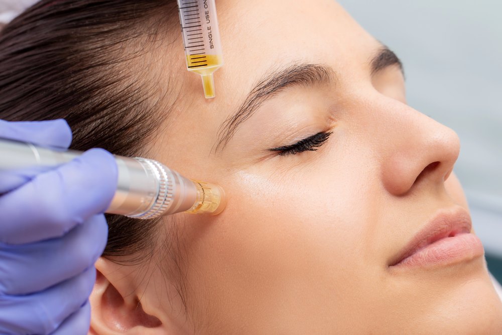 10 Things You Need to Know About Skin Needling