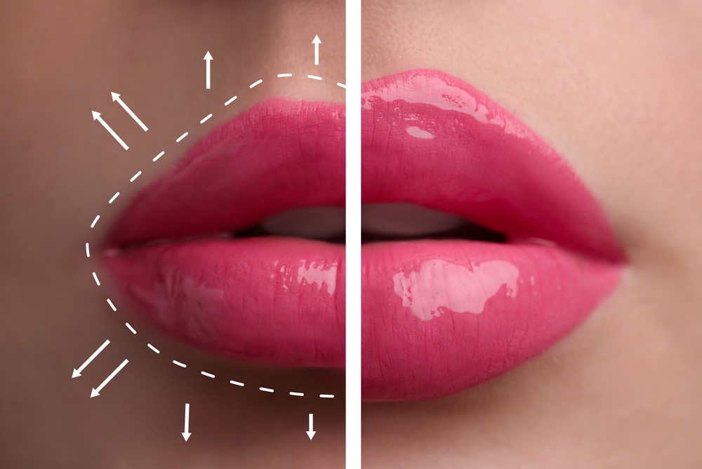 lip filler
