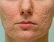 How Can Aesthetic Clinic Help Improve Your Acne Scar