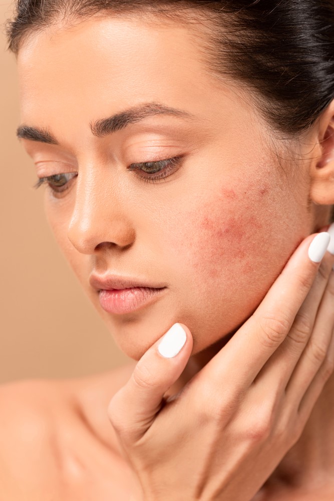 acne scars on a lady's face