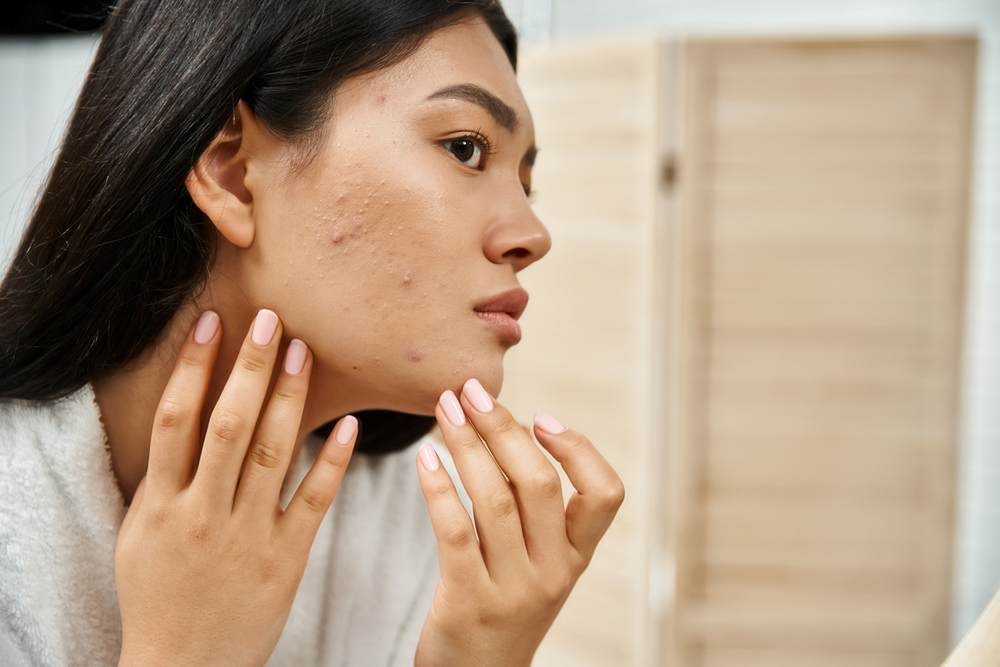 a lady who needs a acne scar treatment