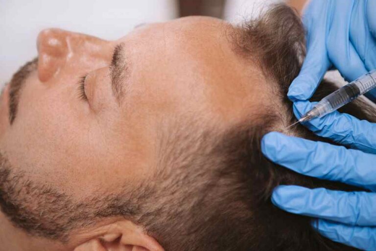 prp hair treatment