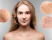 Microneedling for Acne Scars