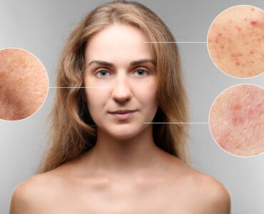 acne scar
