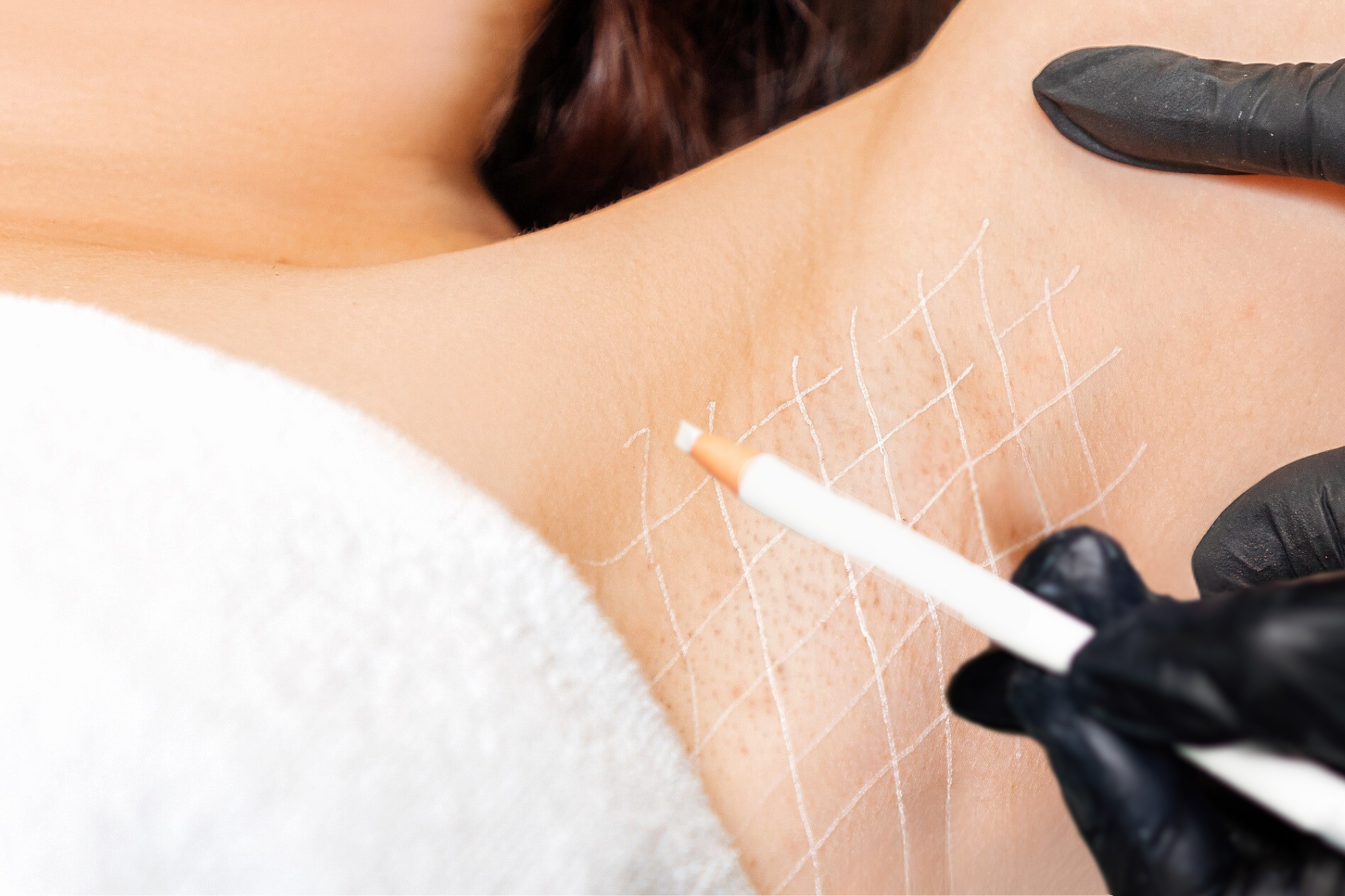Excessive Sweating (Hyperhidrosis)