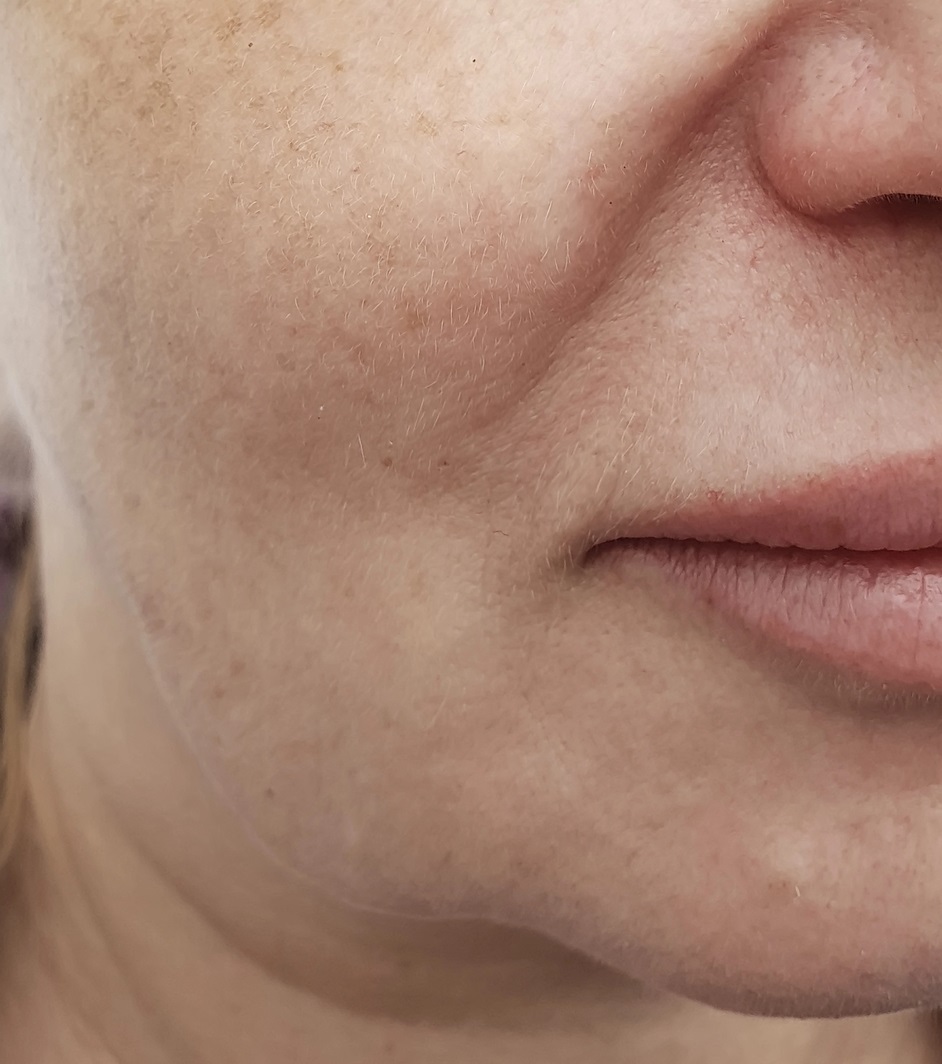 Nasolabial Fold & Facial Skin Sagging