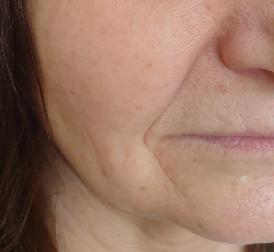 Nasolabial Fold & Facial Skin Sagging