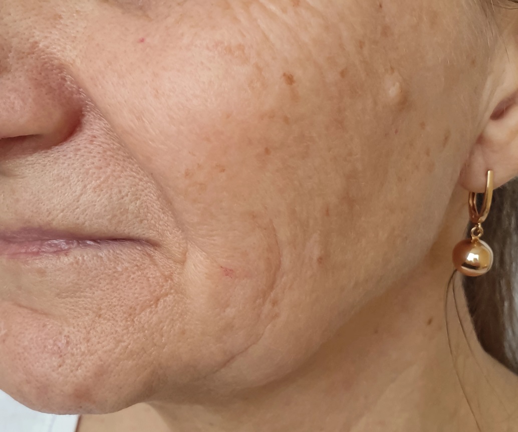 Nasolabial Fold & Facial Skin Sagging