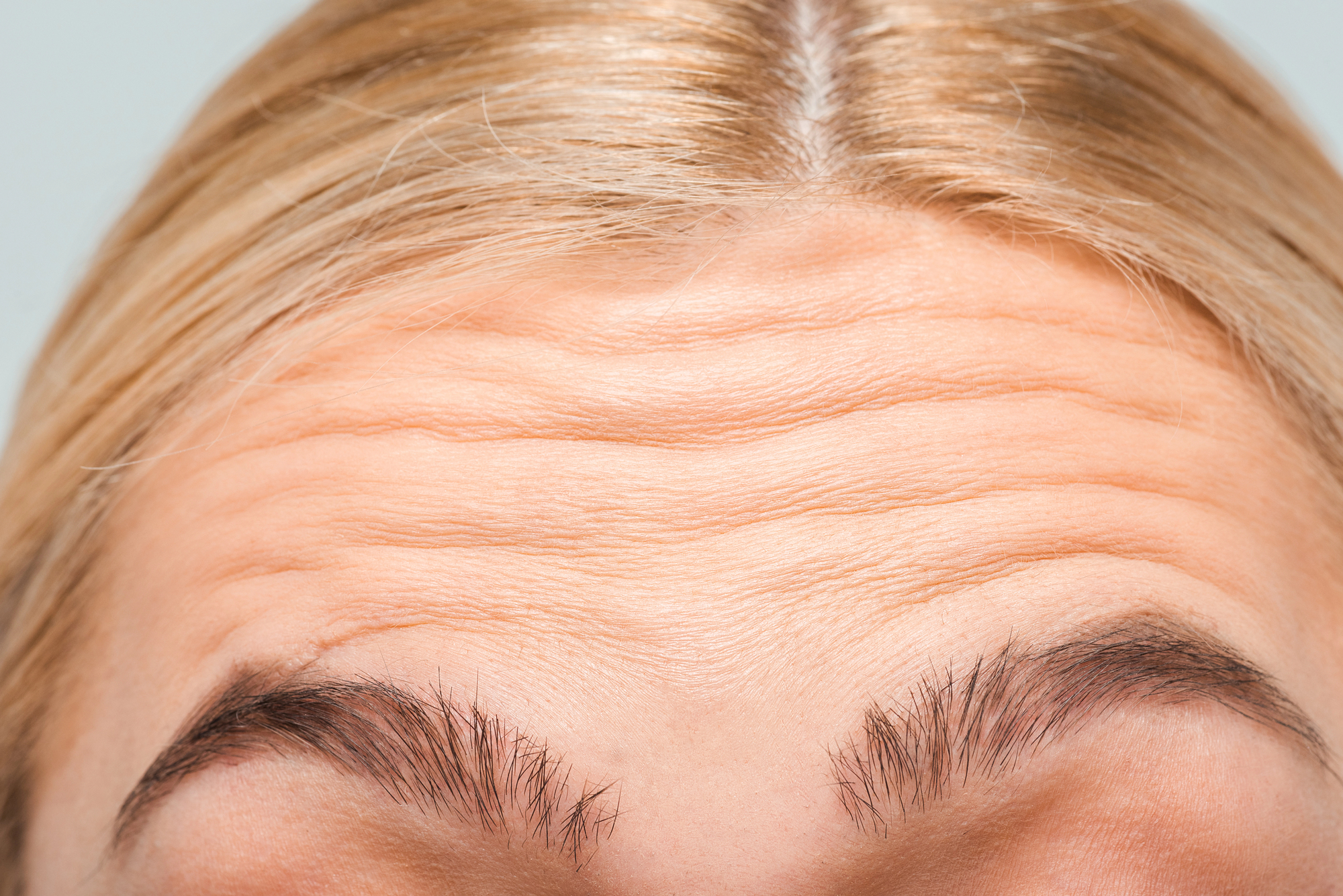 Dynamic Lines: Forehead Lines