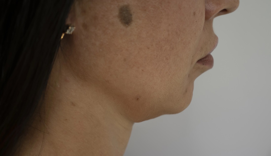 Poor Appearance of Chin & Jawline Contour