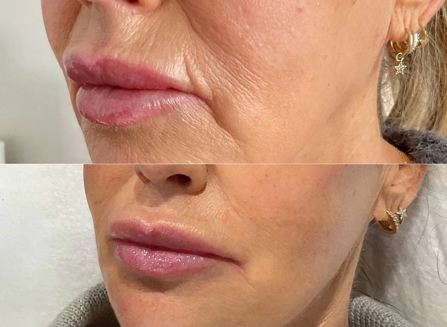 REJURAN - Fine Lines