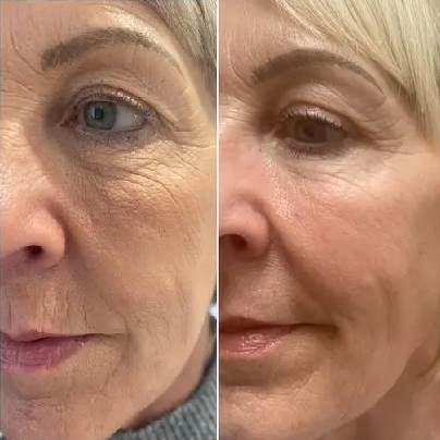 REJURAN Healer Classic Before & After