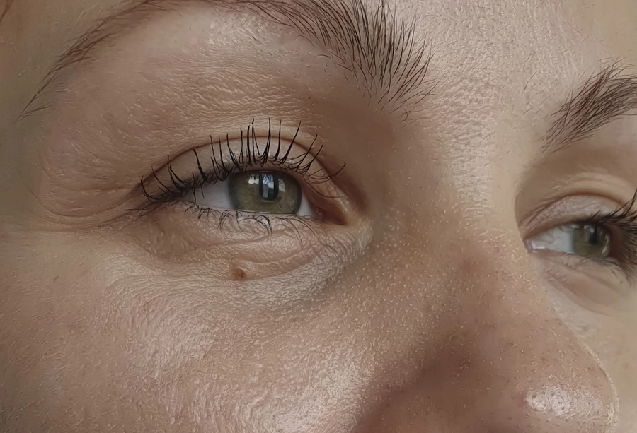 Under-Eye Area Hollowing