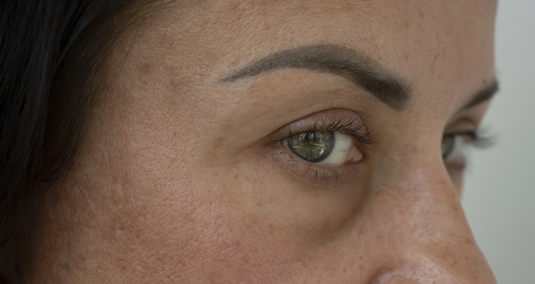 Under-Eye Area Hollowing