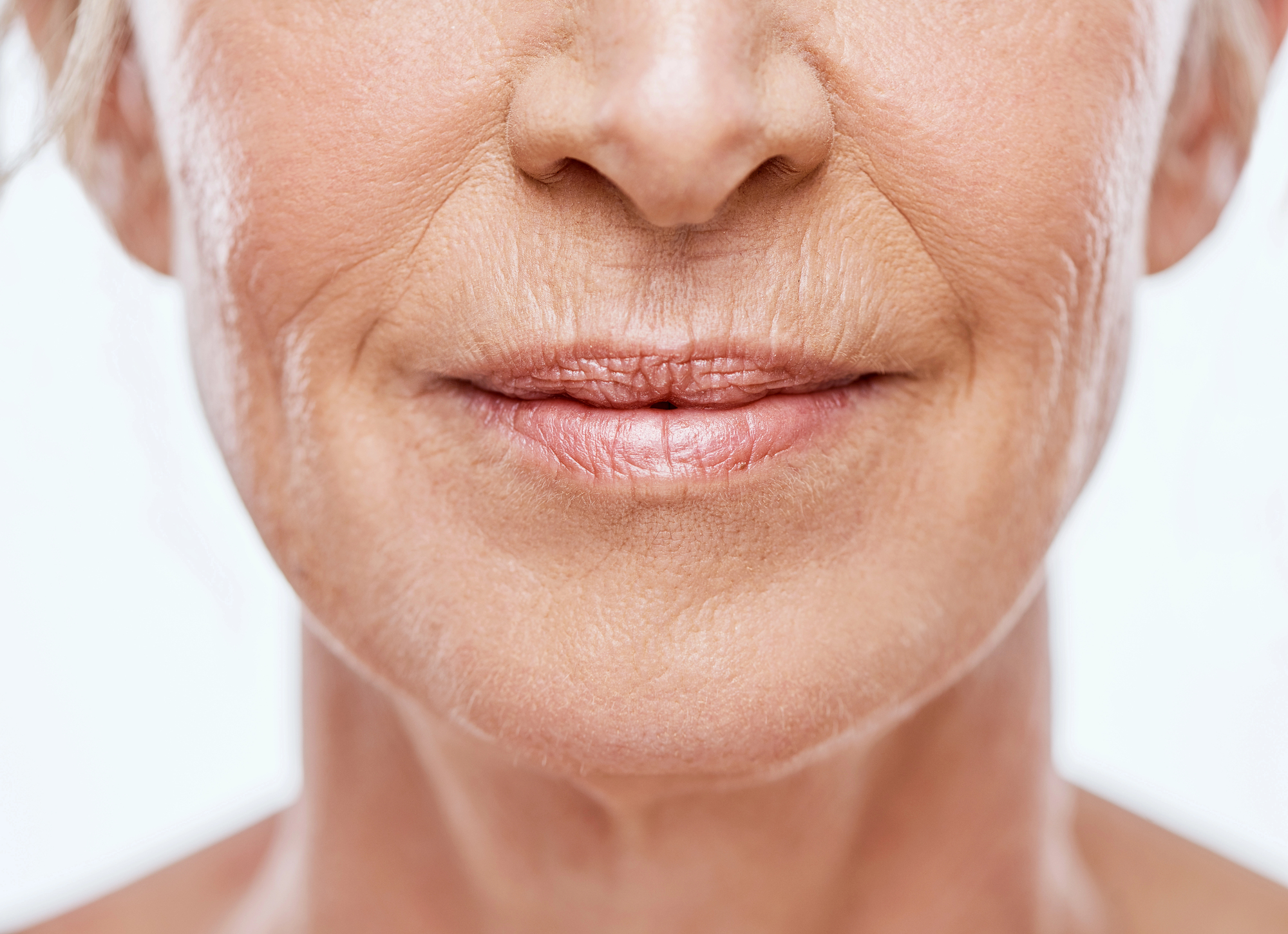 Static Lines: Vertical Lip Lines (Smoker Lines)
