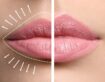 5 Most Common Questions People Ask About Lip Filler