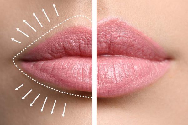 lip filler comparison