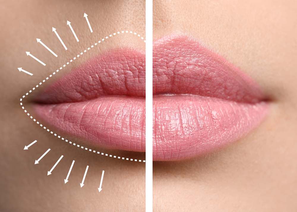 lip filler comparison