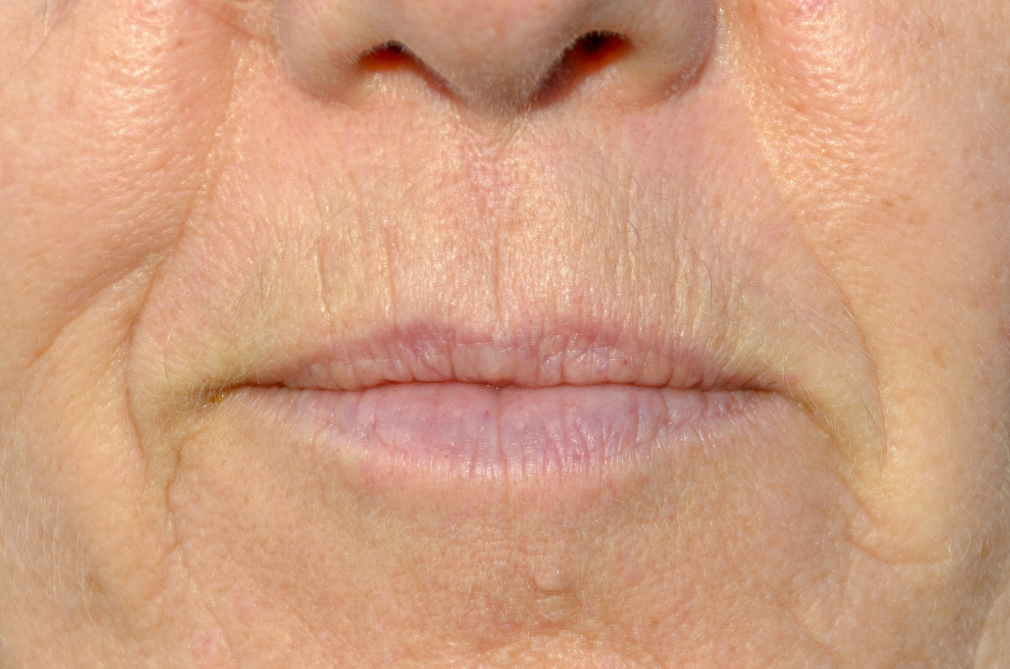 Advanced Lip Volume Loss & Perioral Lines