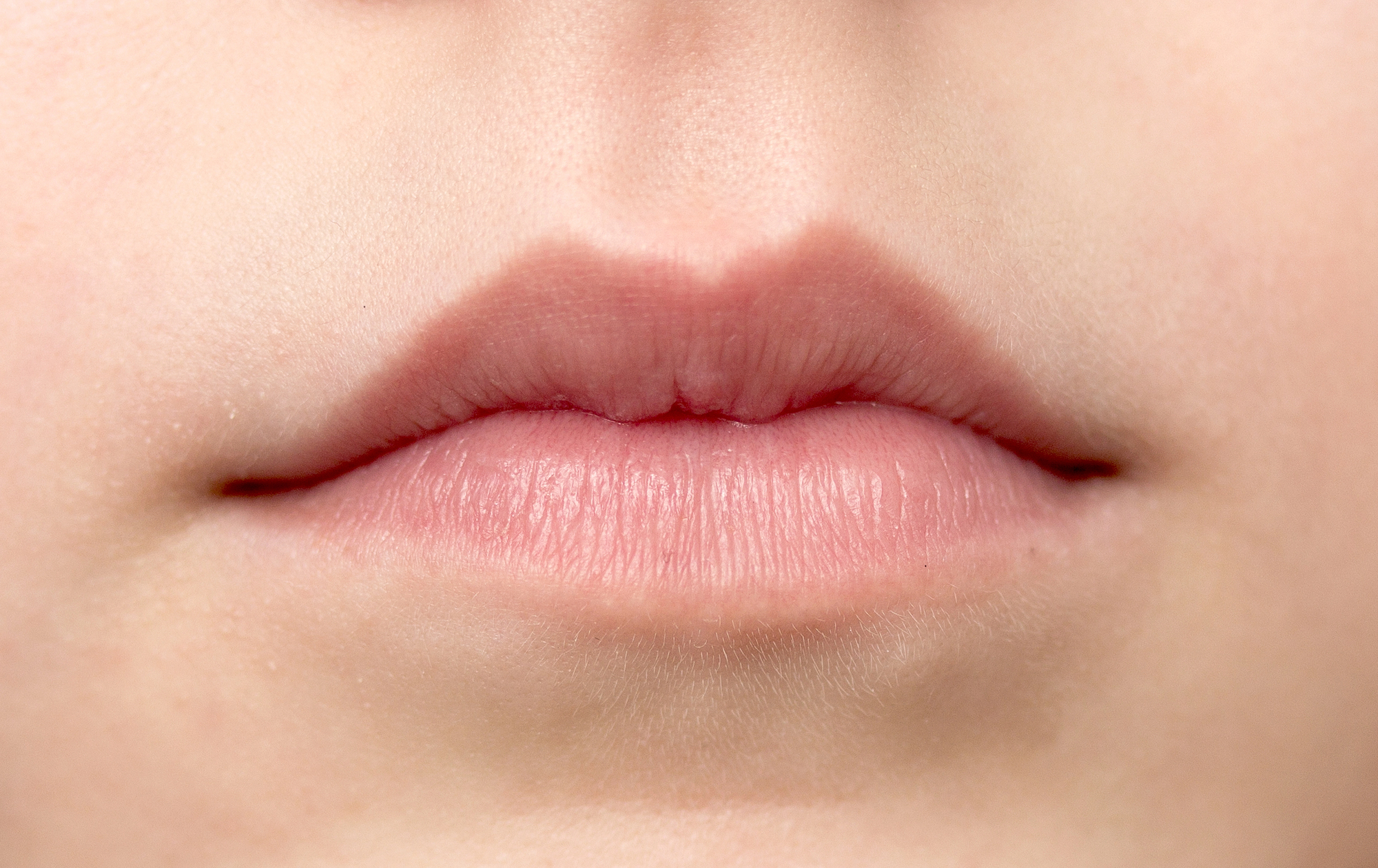 Irregular Upper Lip Shape & Cupid’s Bow Imbalance