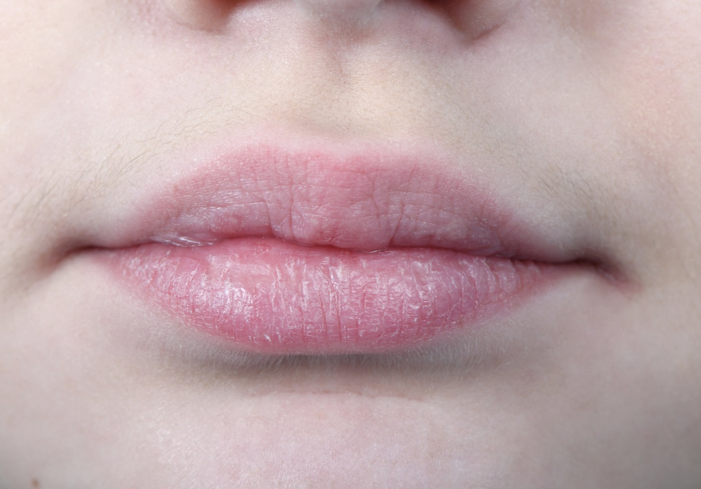Lip Asymmetry & Volume Imbalance