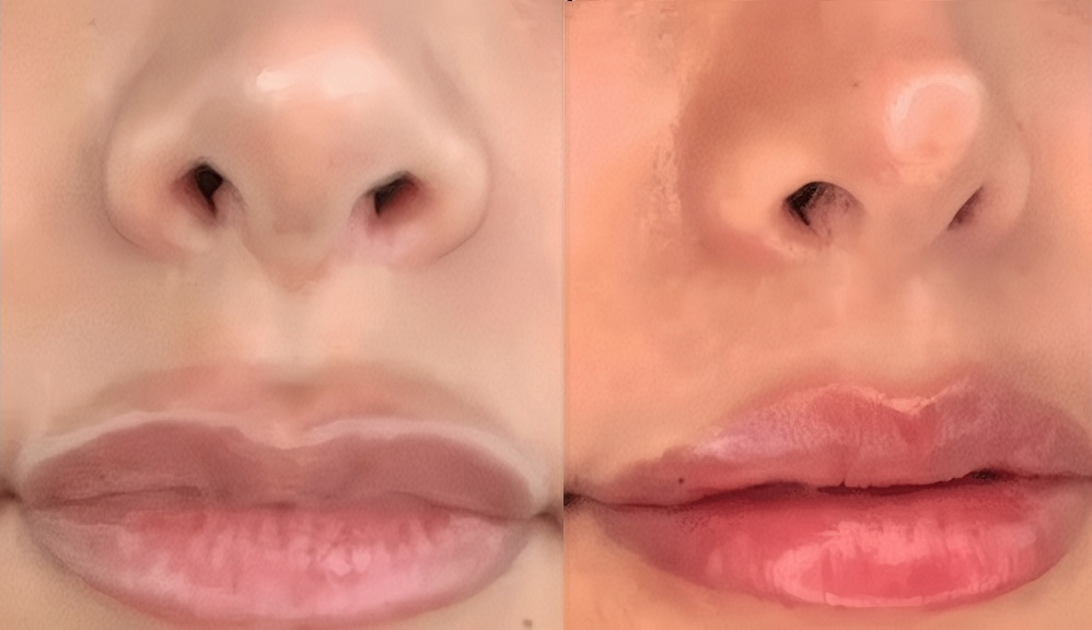 Lip Filler Migration - Upper Lip