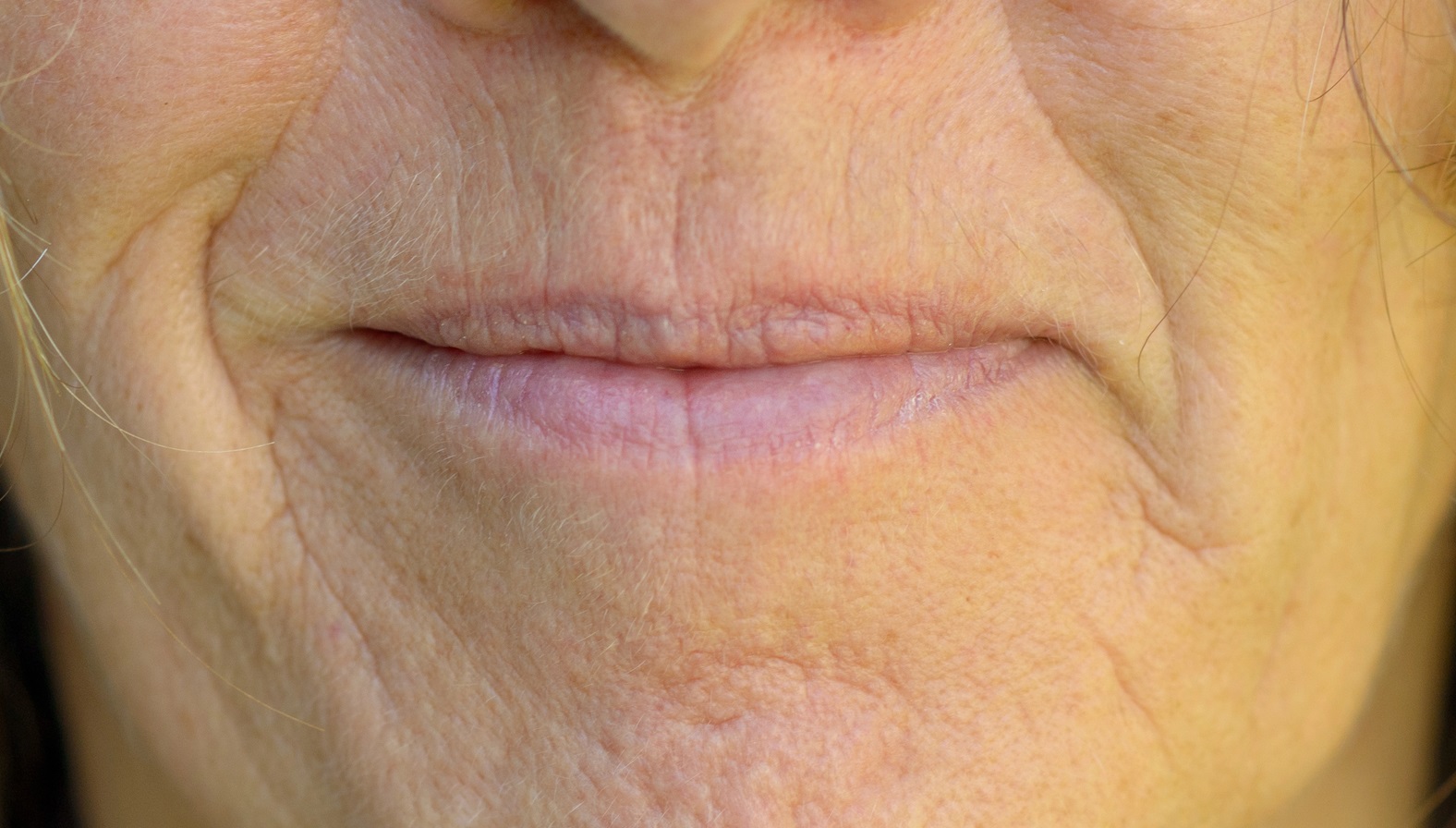Lip Volume Loss & Marionette Area Sagging