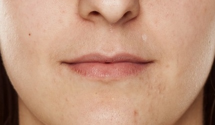 Thin Upper Lip & Reduced Definition