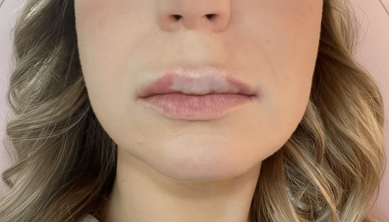 Lip Blanching - Potential Sign of Vascular Occlusion