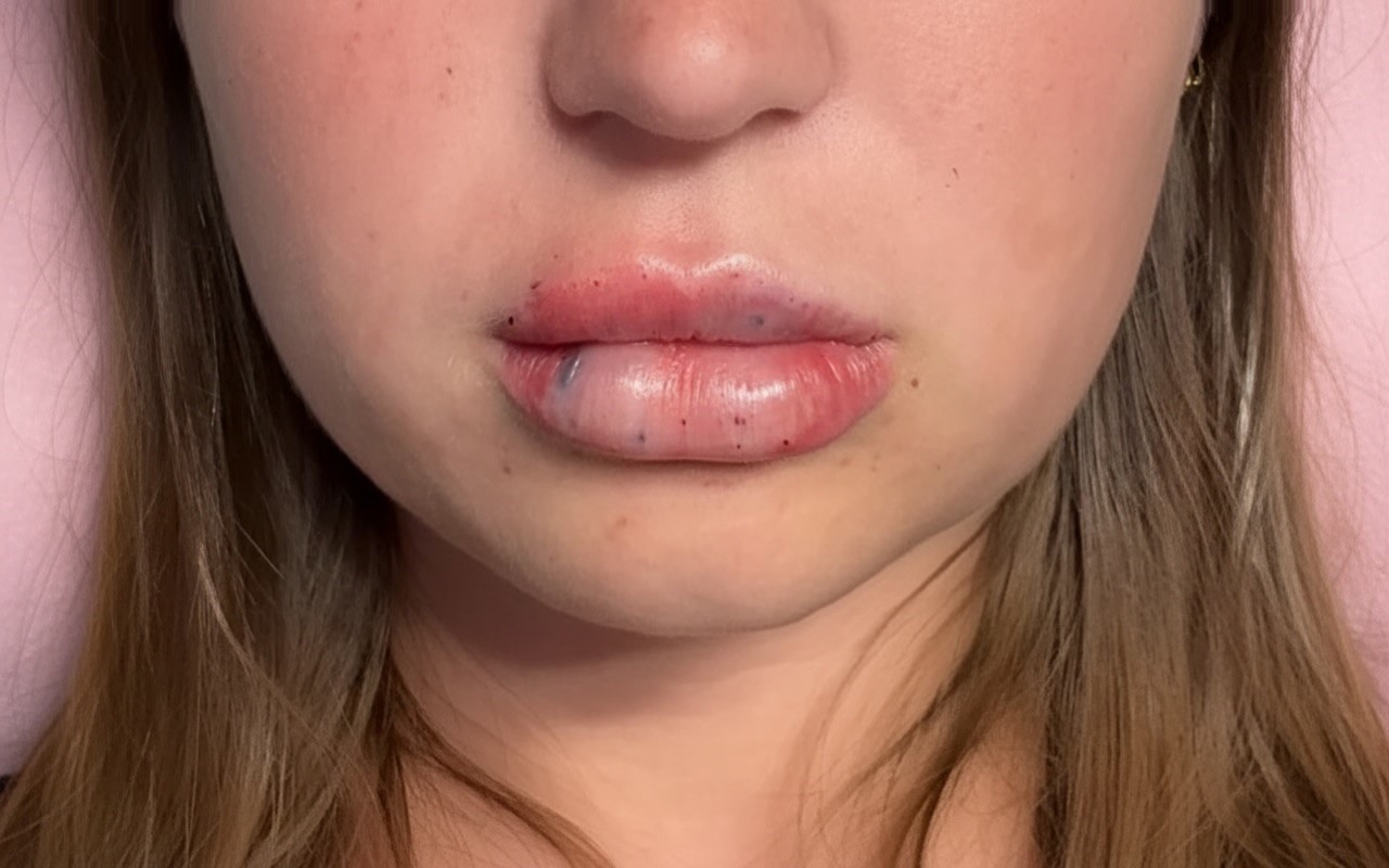 Lip Blanching & Reported Pain - Potential Sign of Vascular Occlusion